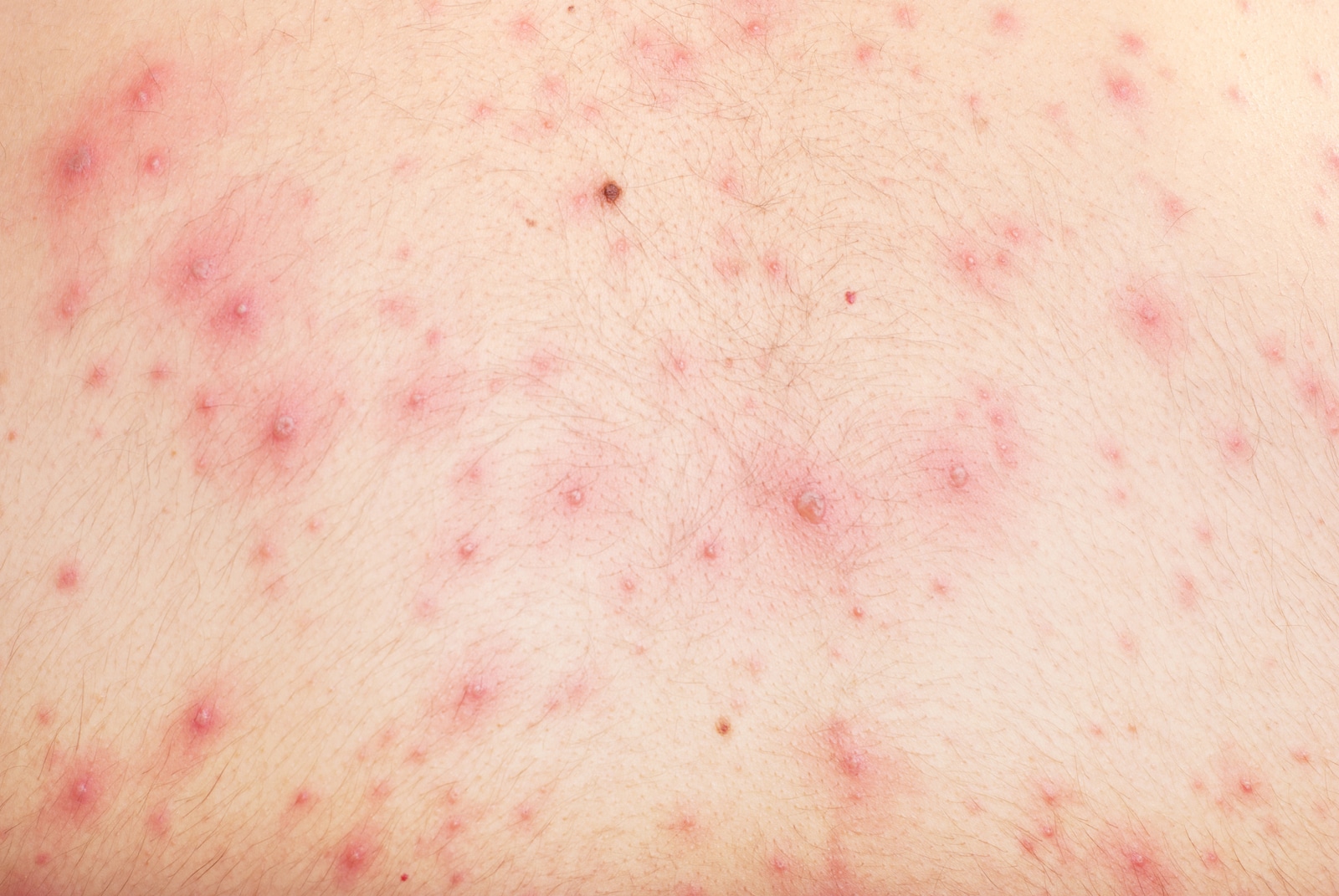 view close up skin red papules chickenpox